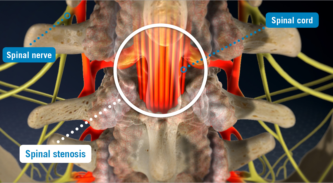 Lumbar Stenosis: Causes, Symptoms and Treatment Options for Narrowing of  the Spinal Canal and Its Impact on Lower Back Pain - Atlantic Spine  Specialists